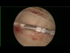 HYSTERSCOPIC Copper T removal