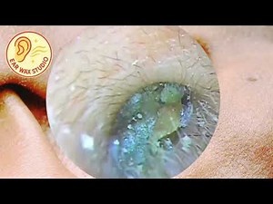 Amount of Ear Wax Removed | Deep Ear Cleaning at Ear Wax Studio