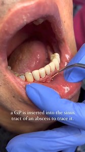 1.3K views · 31 reactions | How to identify the culprit! A brief demonstration on how an abscess is traced to the source of infection! This is a very simple and basic trick to use when in doubt. In this case, all the teeth near the sinus tract were root canal treated - no TTP or symptoms, which made it even harder to diagnose. Credit @doctorsolo #Dentistry #LearningTips #BitesnBraces | Bites & Braces Dental | Facebook