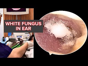 White Fungal Removal 👂 耳掃除で癒される | Doctor Anh