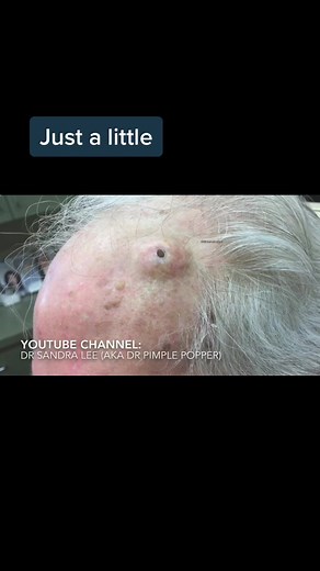 Extracting a HUGE Blackhead with the Biggest Comedone Extractor Ever!