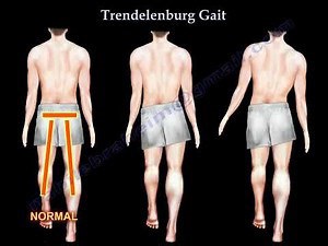 Trendelenburg Gait: Causes, Symptoms, and Role of the Gluteus Medius