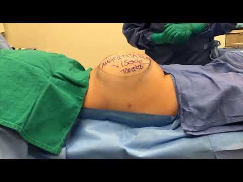 Dr. DuPéré LIVE Surgery: Buttock Augmentation
