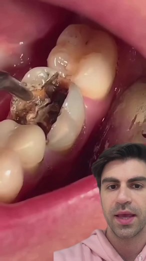 Dr. Kadish (@drkadish) - Understanding Broken Tooth: Causes, Treatment, and Prevention
