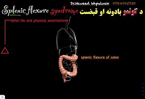 د کولمو بادونه او قبضیت Splenic flexure Syndrome: د کولمو د بادونو او شدید قبضتونو علتونه څه دي ؟ څنګه یې درملنه وکړو ؟ #داکترنویدخپلواک معلوماتو څانګه: 0784905730-0777905730 | Dr Naweed Khpulwak