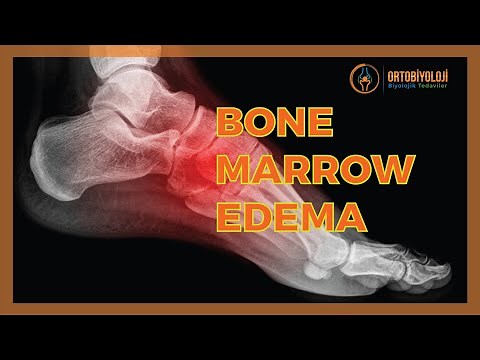 BONE MARROW EDEMA TREATMENTS