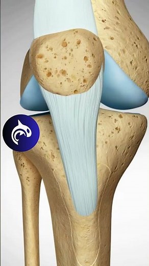 See how a Misaligned Knee Cap is fixed // Tibial Tubercle Osteotomy (TTO)