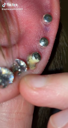 My Daughter’s ear piercing 🤢 #Piercing #GoneWrong #Infected #Nasty