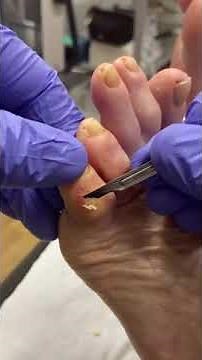 Corn Removal by Podiatrist: Expert Solutions for Little Toe Corns