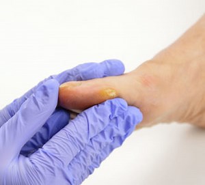 5 Common Problems That Affect Your Big Toe | Atlanta Foot Doctor