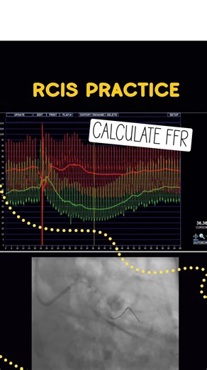Don’t Miss A Beat ®️ on Instagram: "how to calculate FFR by request ✍🏼 for this type of wire based FFR, usually adenosine will be given and you will look for a hyperemic effect if coronary perfusion is affected you will see a reduction in Pd pressure distal to the lesion locate the greatest different between Pd and Pa (without artifact) and calculate the ratio"