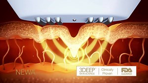 1.2M views · 562 reactions | NEWA is the ONLY home skin care device that is clinically proven to rebuild collagen. Get yours today at www.trynewa.com | NEWA | Facebook