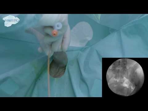 Emptying the bladder