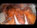 Mucosal Perforation During Laparoscopic Heller Myotomy Suture and Fat Pad Treatment • Video • MEDtube.net