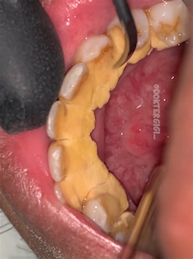 Essential Tips for Effective Tartar Cleaning