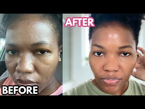 Tretinoin: How I use it For A Flawless Uniform Dark Skin (STOP ACNE)-Dry/Mature/Oily/Sensitive Skin