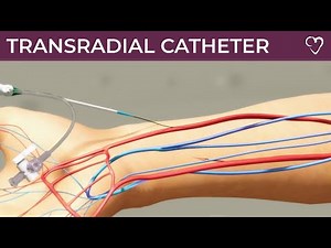 Transradial Catheter