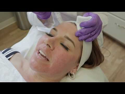 SkinPen: My Microneedling Experience