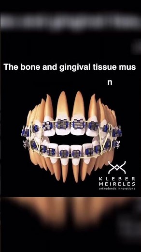 Elastics for closing an open bite - ORTHODONTIC TIPS #Shorts