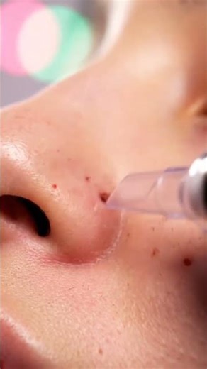 “Millions of Tiny Blackheads Lifted With Pore Vacuum!”
