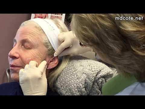 Nova Threads for Neck and Jawline Lifting