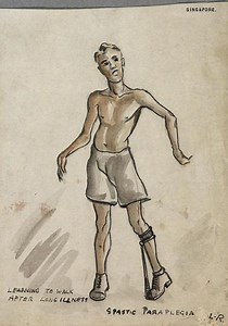 Modified Ashworth Scale