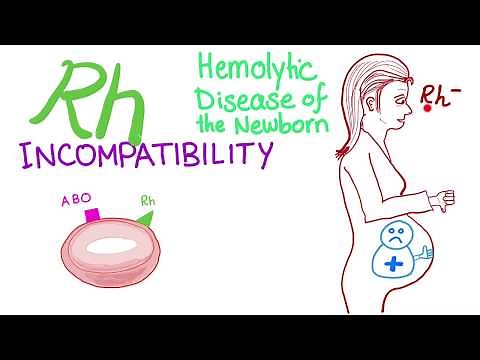 Rh incompatibility - Hemolytic disease of the newborn (HDN) - Erythroblastosis fetalis - Hemolysis