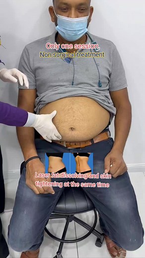 Laser Lipolysis for Fat Dissolving and Skin Tightening