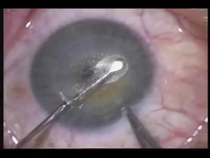 ReLEx SMILE: Least invasive technique for least invasive laser eye surgery