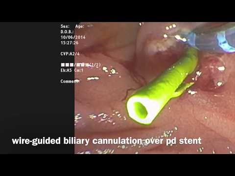 ERCP with pancreatic sphincterotomy and stent placement to access bile duct for stone removal