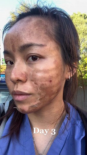 TCA Chemical Peel Journey: Achieve Glowing Skin with Before and After Results