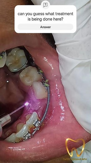 Orthodontic tooth exposure| Laser| Perio-Ortho surgical case #laser #ortho #shorts #shortsviral #yt