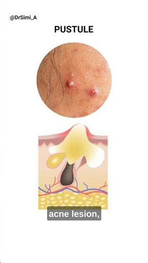 Acne Pimple Pus: How to Get Rid of It | #acne #shorts