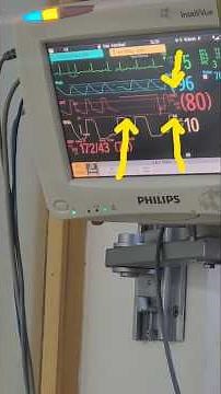 how to do flush test or square test in arterial line.