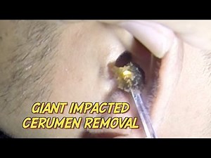Giant Impacted Cerumen Removal