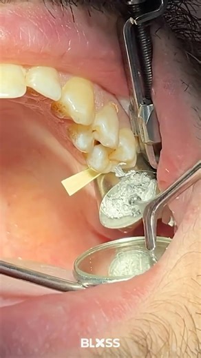 Fixing a Cavity… But Make It Satisfying 🤯