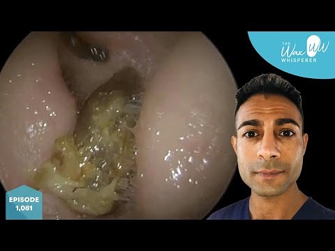 1,081 - Severely Blocked Ear Wax Removal with Dead Skin