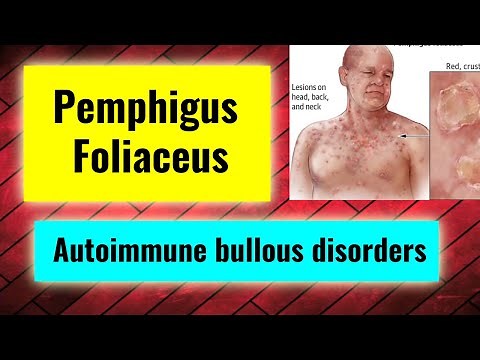 Pemphigus Foliaceus overview, treatment, management (Autoimmune bullous disorders Part 3)