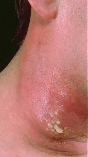 Furuncle and Carbuncle short Urdu video