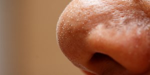 How To Get Rid Of Whiteheads On Nose?