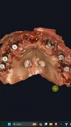 Short tutorial on iCam library modifications for exocad.