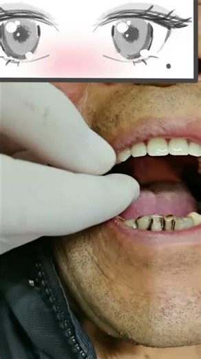 A new partial denture@Acrylic Denture