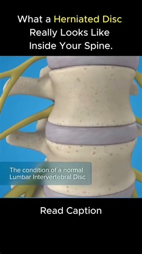 Your Disc Never “Slipped” - This Is the Real Science Behind Back Pain