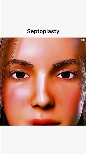 Septoplasty