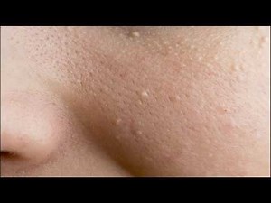 Milia Removal at Home