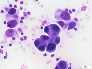Adenocarcinoma in lung/mediastinum on cytology