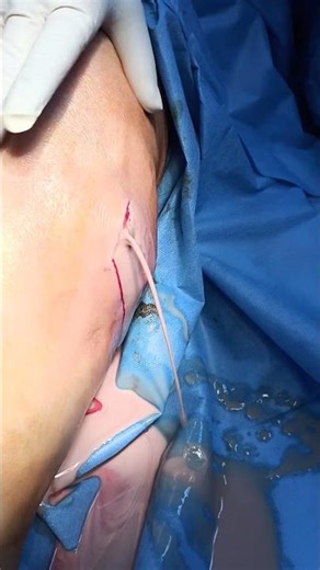 Thigh Abscess Drainage