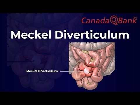 Meckel Diverticulum
