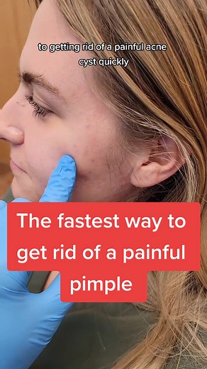 Effective Ways to Remove Painful Acne Cysts
