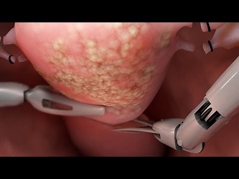 Robotic Hysterectomy